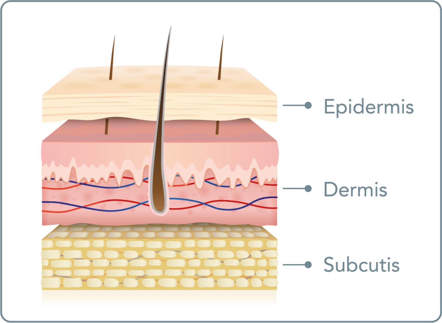 Carboxytherapie - Wie unterscheidet sich die intradermale von der subkutanen Anwendung?
