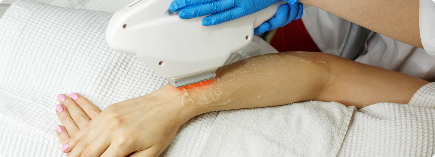 Dauerhafte Haarentfernung - Optische Epilation/Elos-Technologie