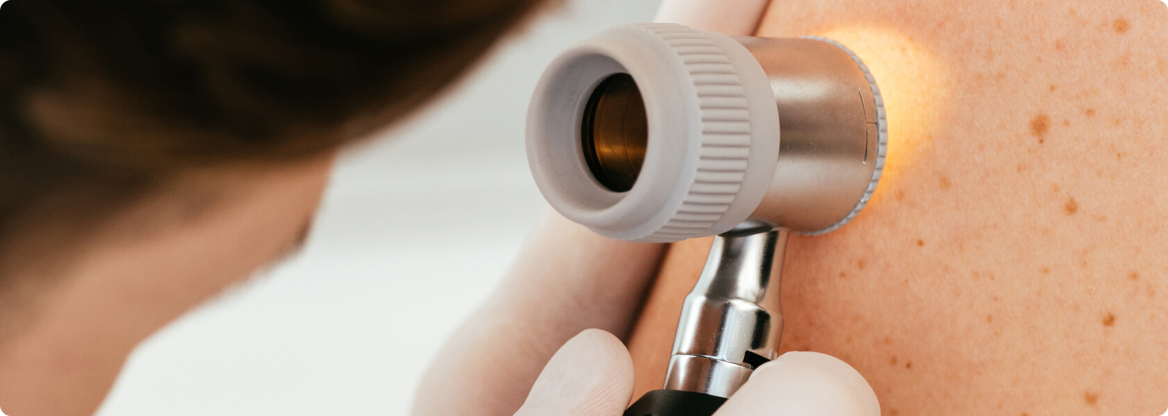 Dauerhafte Haarentfernung - Kann die Lasertherapie Hautkrebs verursachen?
