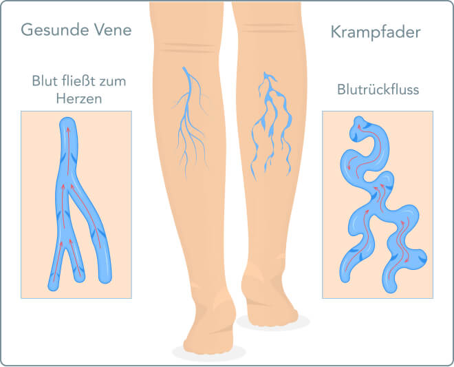 Krampfadern - Varizen - Wie bekommt man Krampfadern?