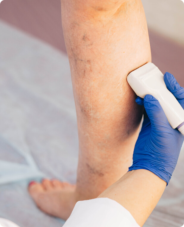 Krampfadern - Varizen - Wie erfolgt die Diagnose der Varizen?