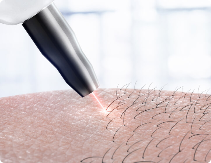 Laser Haarentfernung - Für wen ist die Laser-Haarentfernung geeignet und für wen nicht?