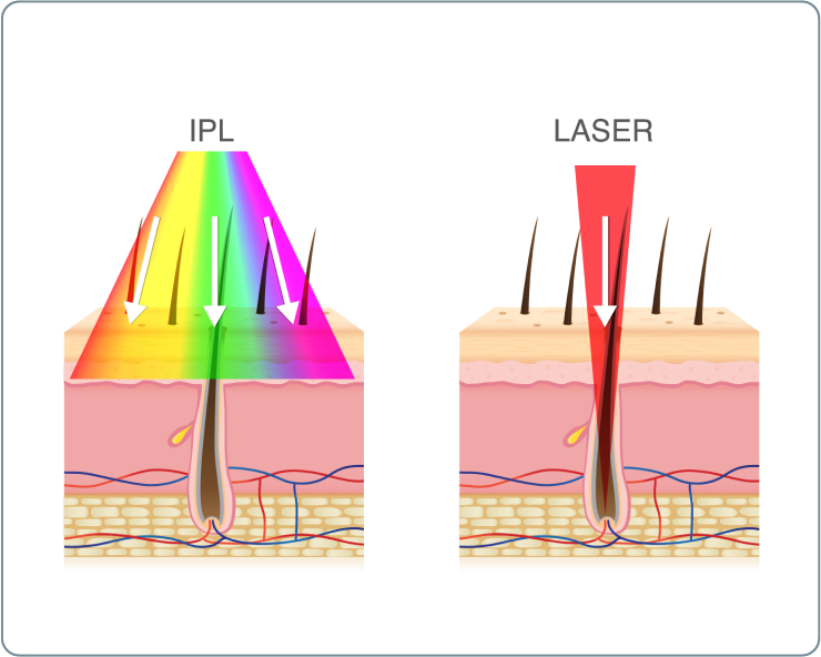 Laser Haarentfernung - Wie unterscheiden sich IPL und Laser-Haarentfernung? 