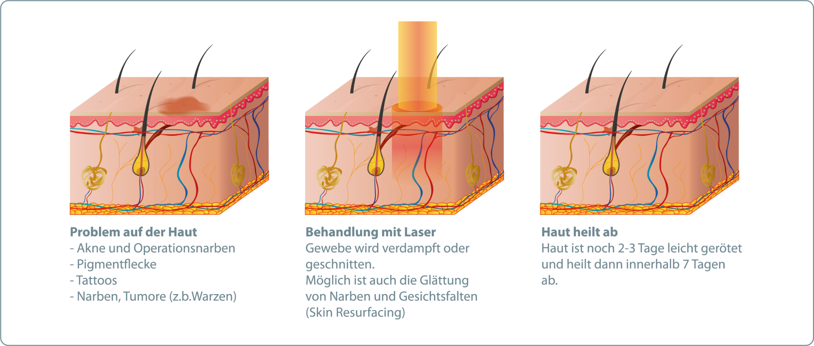 Lasertherapie - Wie läuft eine Lasertherapie ab?