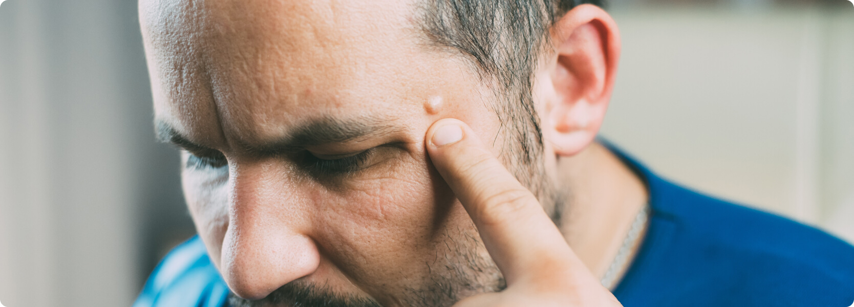 Lipom - Was versteht die Medizin darunter?