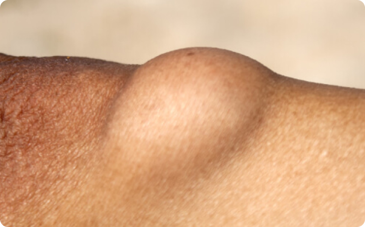 Lipom - Wo tauchen Lipome am häufigsten auf?