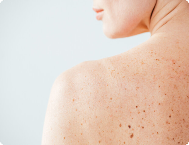 Melasma (Chloasma/Hyperpigmentierung) - Muttermale