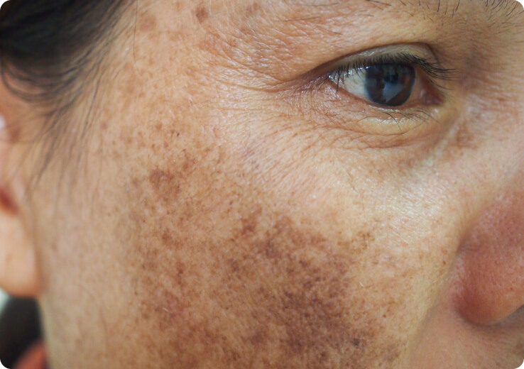 Melasma (Chloasma/Hyperpigmentierung) - Was sind die Anzeichen für ein Melasma?