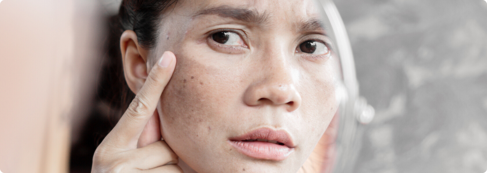 Melasma (Chloasma/Hyperpigmentierung) - Was versteht die Medizin unter einem Melasma?