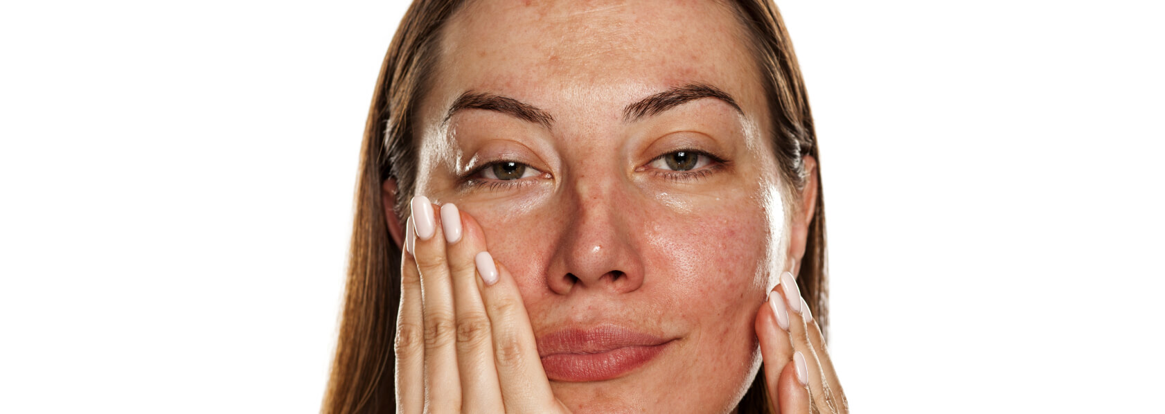 Melasma (Chloasma/Hyperpigmentierung) - Wie lässt sich ein Melasma behandeln?
