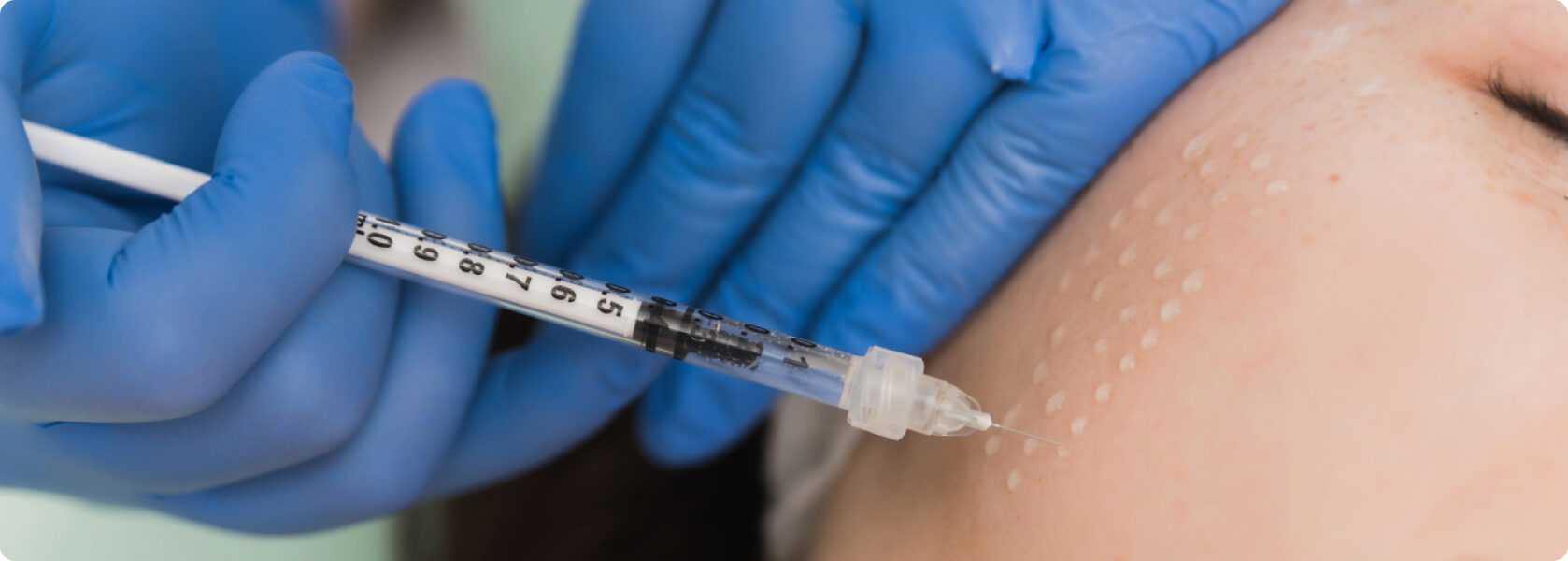 Mesotherapie - Was versteht die Medizin unter einer Mesotherapie?
