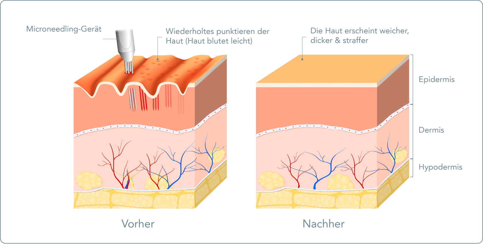 Microneedling - Wie läuft ein Microneedling ab?