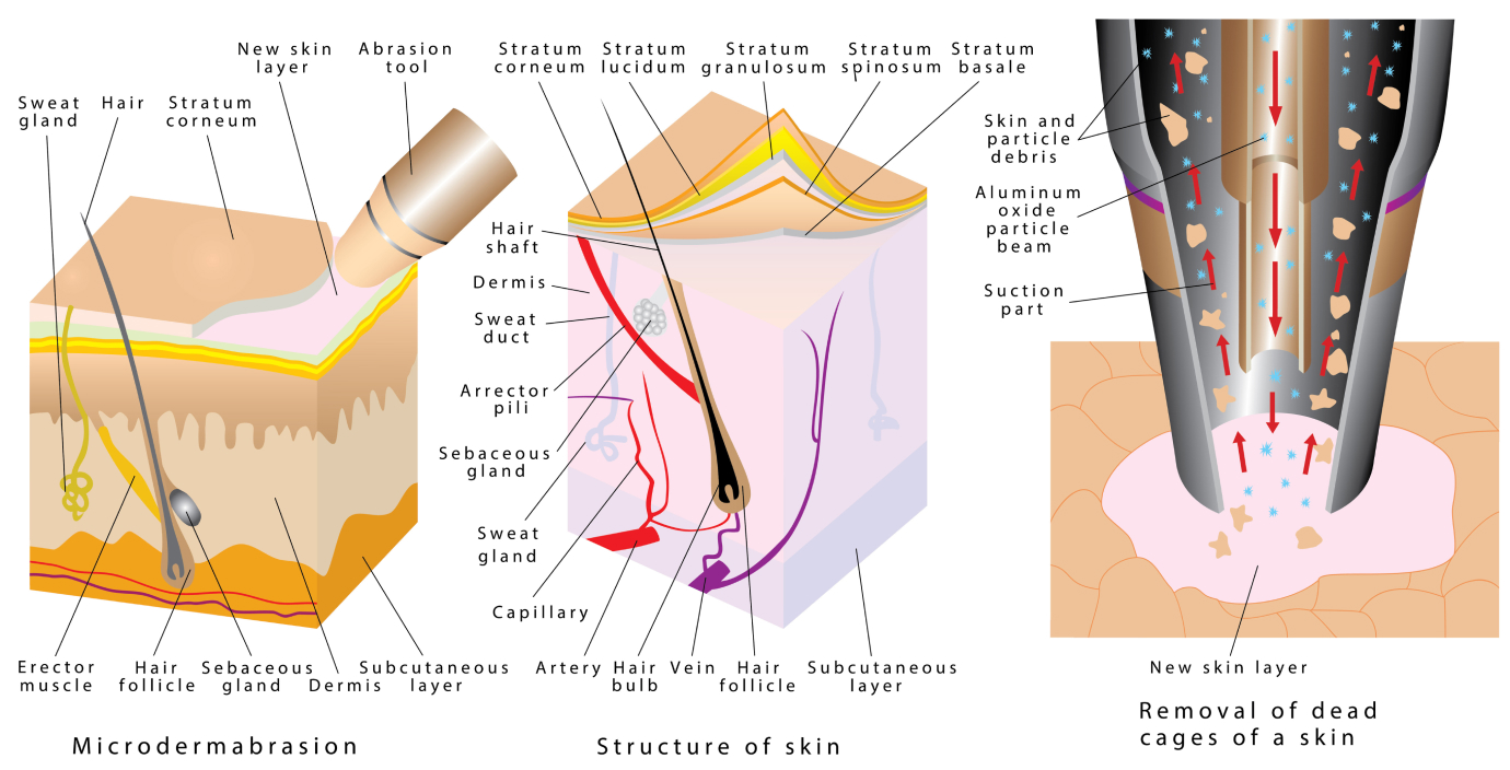 Mikrodermabrasion (Microdermabrasion) - Wie funktioniert die Mikrodermabrasion?