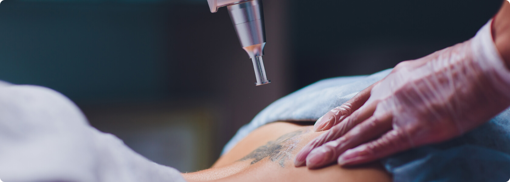 Tattooentfernung - Ist das Lasern krebserregend?