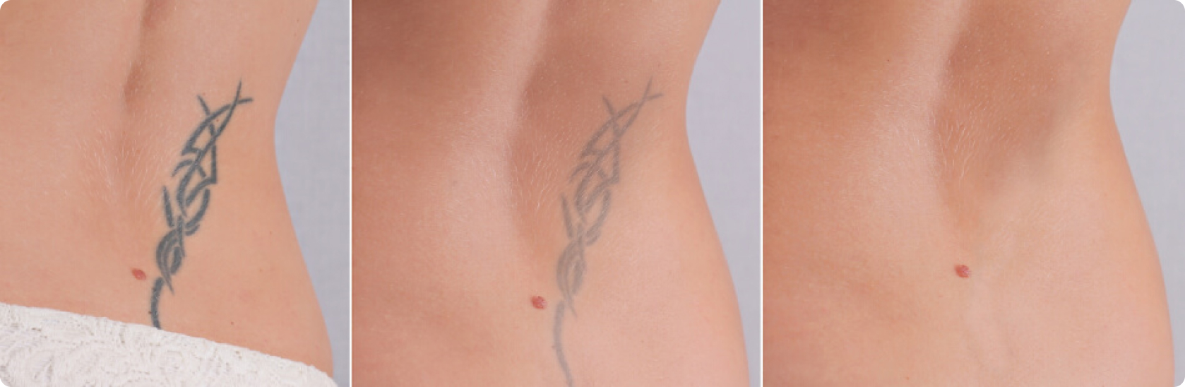 Tattooentfernung - Kann man ein Tattoo immer zu 100% entfernen lassen?