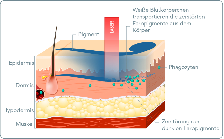 Tattooentfernung - Wie funktioniert die Entfernung eines Tattoos mittels Laser?