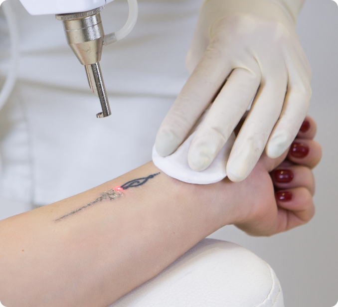Tattooentfernung - Wie lässt sich ein Tattoo weglasern?