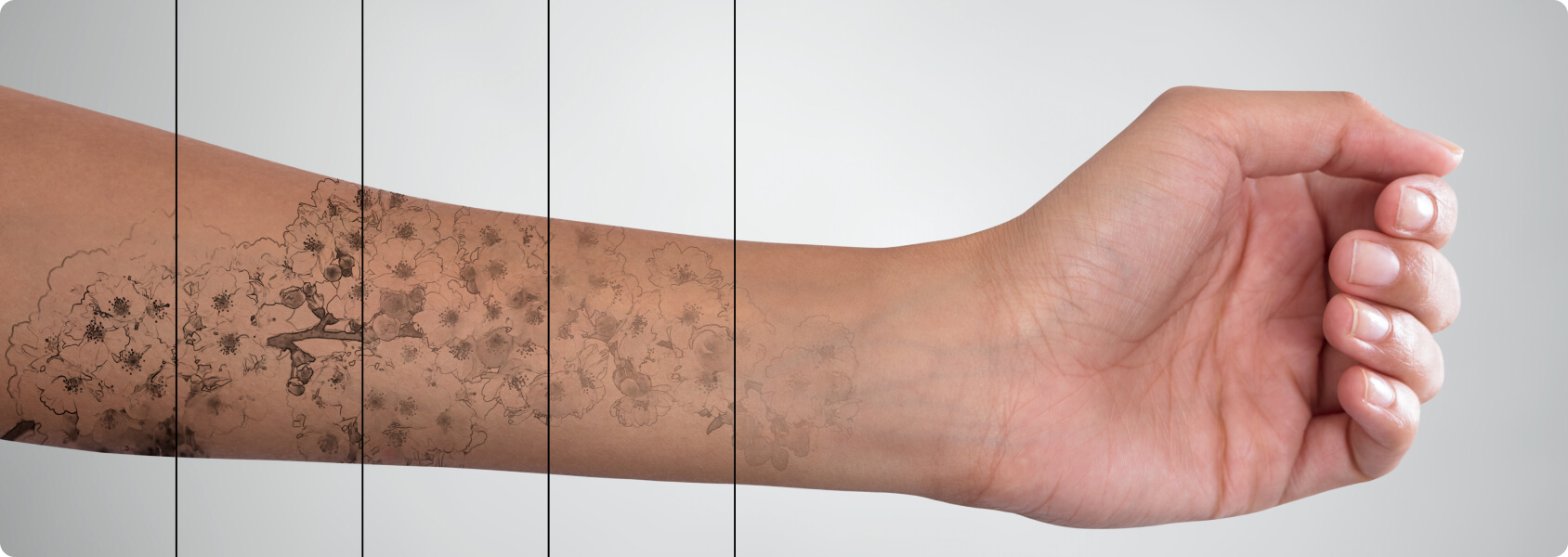 Tattooentfernung - Wie viele Lasersitzungen braucht es, bis das Tattoo komplett verschwunden ist?