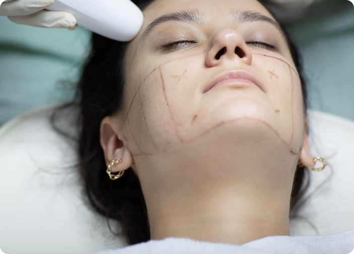 Ultherapy® - Wie genau läuft eine Ultherapy®-Behandlung ab?
