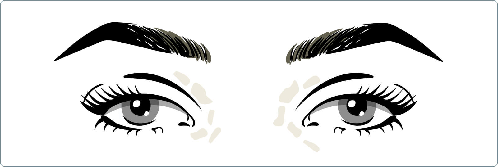 Xanthelasmen - Was versteht die Medizin unter einem Xanthelasma?