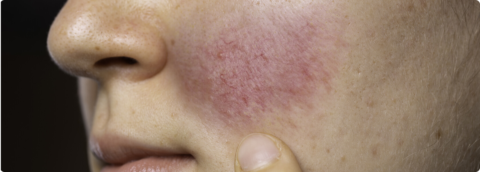 Akne - Was ist der Unterschied zwischen Akne und Rosacea?