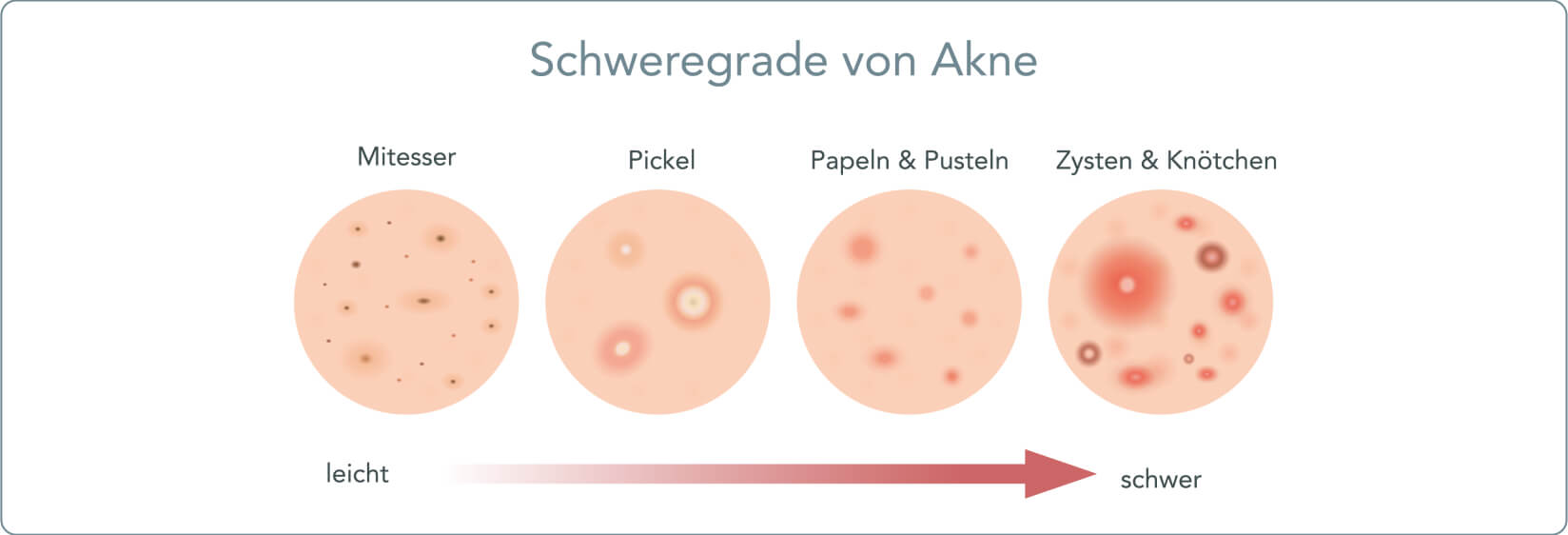Akne - Wie äußert sich die Akne vulgaris?