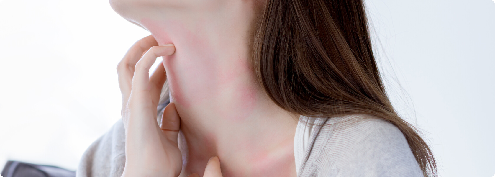Allergie - Ist ein Arzneimittelexanthem eine Allergie?