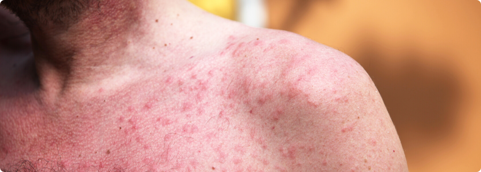 Allergie - Was ist unter einer Mallorca Akne zu verstehen?