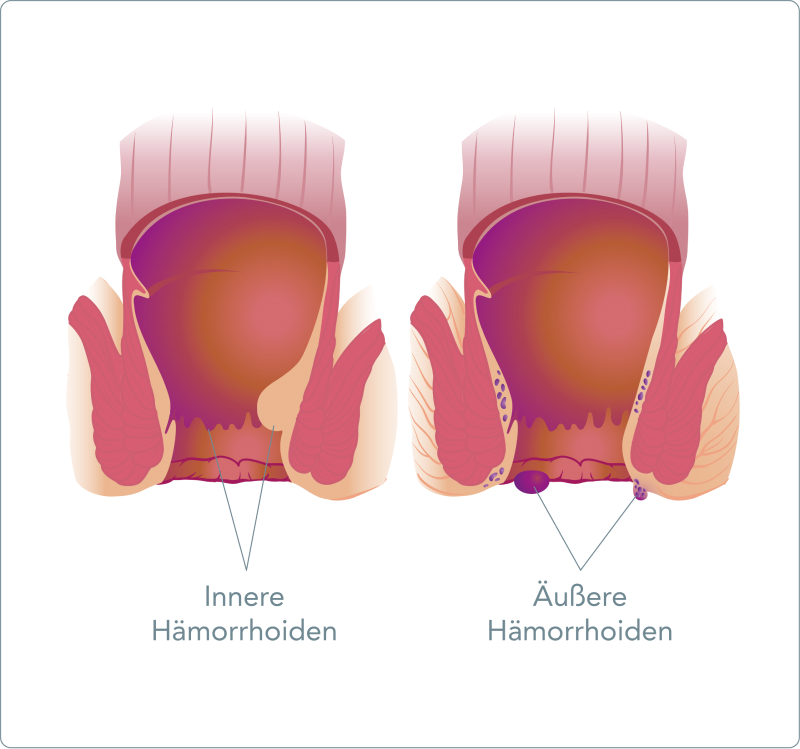 Analekzem - Was ist der Unterschied zwischen einem Analekzem und Hämorrhoiden?