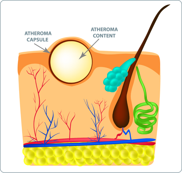 Atherom - Atherom entfernen
