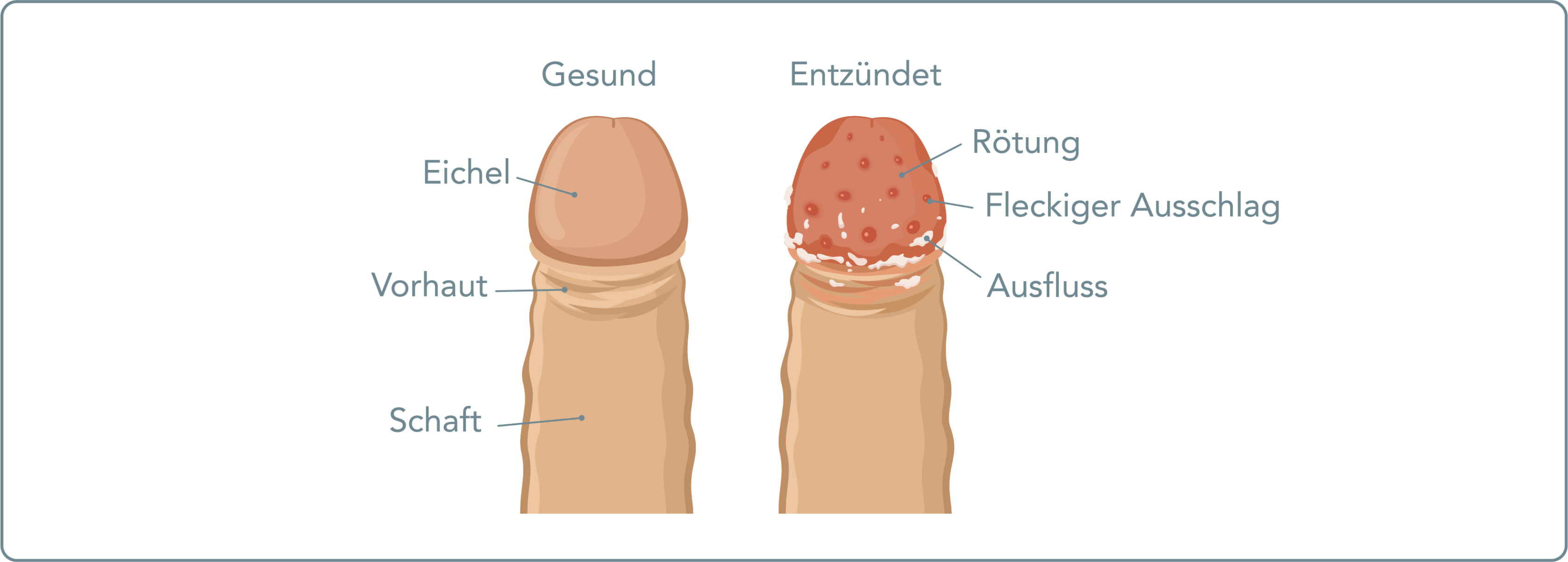 Balanitis - Welche Ursachen hat eine Balanitis?