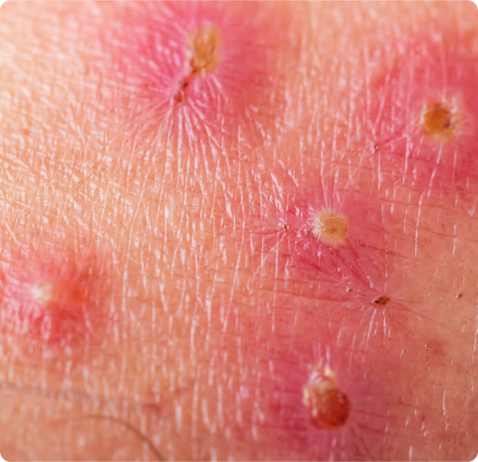 Borkenflechte (Impetigo contagiosa) - Die großblasige Form zeigt sich durch ein bis zwei Zentimeter große Bläschen