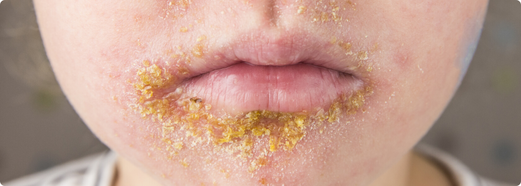 Borkenflechte (Impetigo contagiosa) - Was sind die möglichen Differenzialdiagnosen bei einer Impetigo contagiosa?