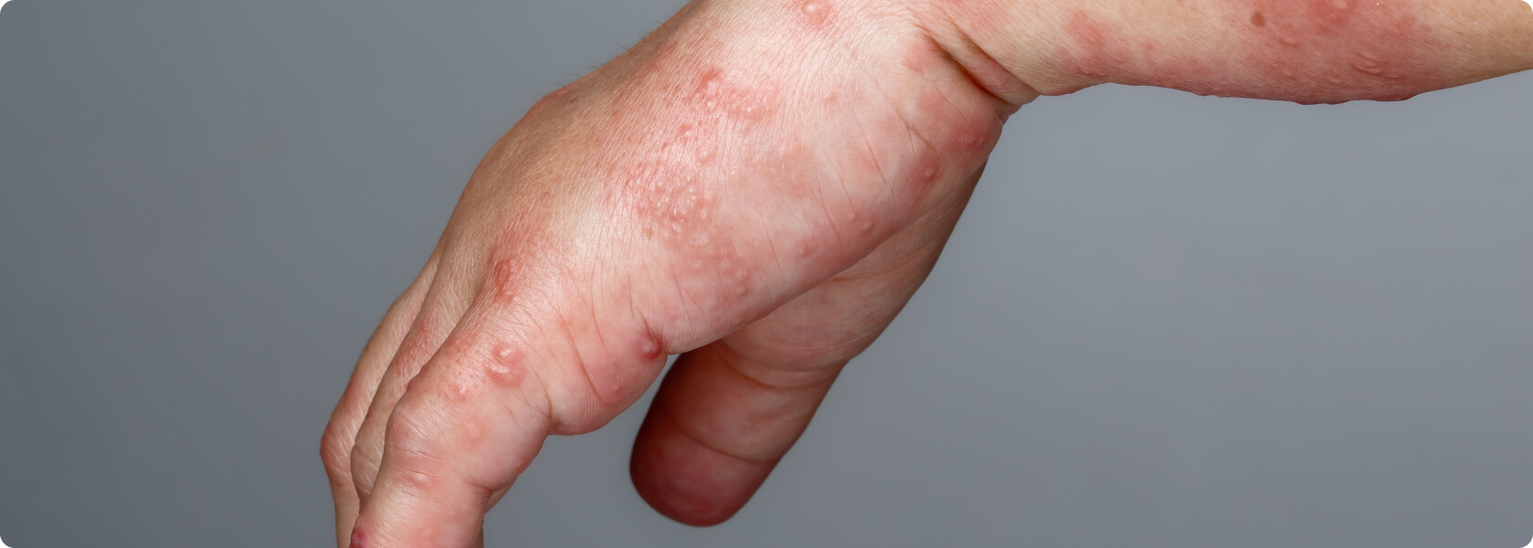 Bullöses Pemphigoid - Welche Folgen hat ein bullöses Pemphigoid für Betroffene?