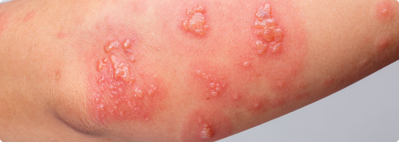 Bullöses Pemphigoid - Was versteht die Medizin unter einem bullösen Pemphigoid?