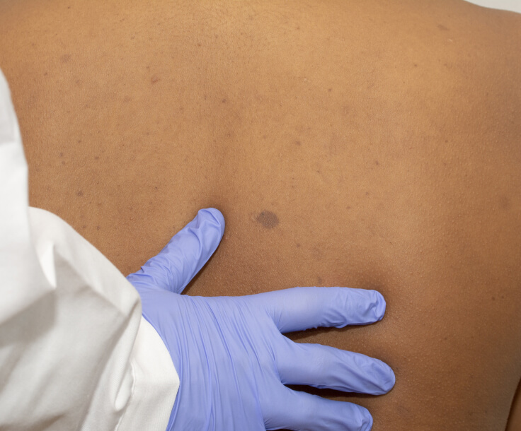 Café-au-lait-Flecken - Kleinkinder ohne Neurofibromatose haben möglicherweise zwei bis drei Café-au-lait-Flecken