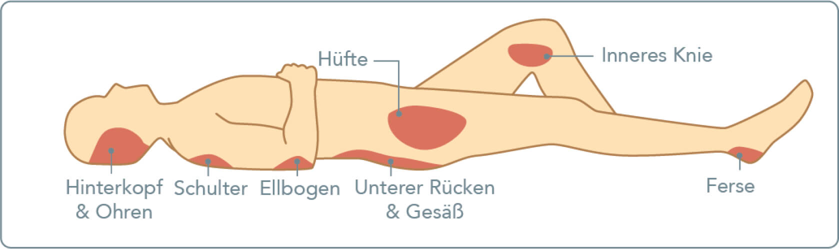 Dekubitus - An welchen Körperstellen kann ein Dekubitus auftreten?