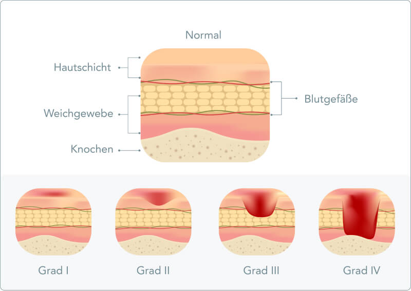 Dekubitus - Welche Grade des Dekubitus gibt es?