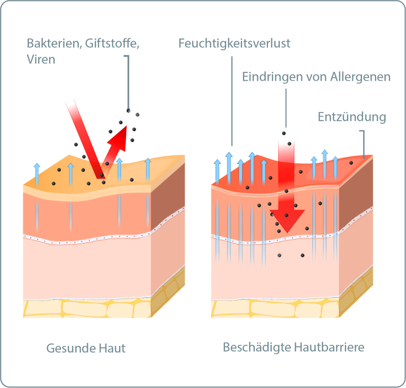 Dermatitis - Welche Ursachen hat eine Dermatitis?