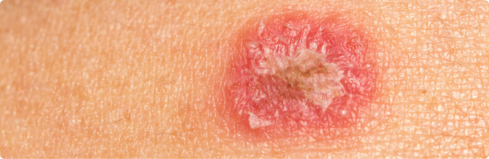 Tinea (Dermatophytose) - Welche Formen der Tinea gibt es?