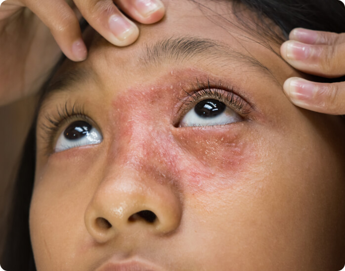 Tinea (Dermatophytose) - Welche Ursachen hat eine Tinea?