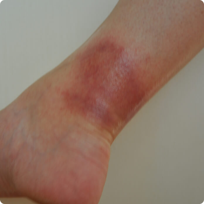Erythema nodosum (Knotenrose) - Steht der Verdacht einer Sarkoidose oder einer Tuberkulose im Raum