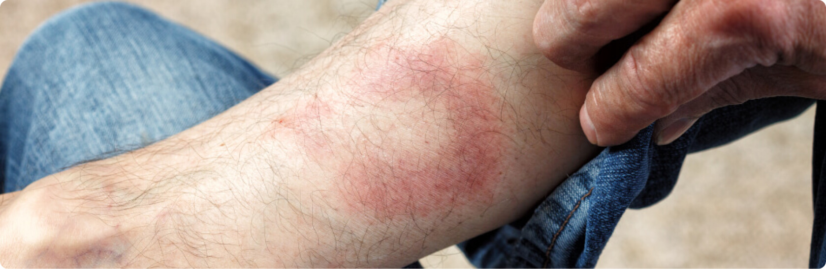 Erythema nodosum (Knotenrose) - Was versteht die Medizin unter einem Erythema nodosum?