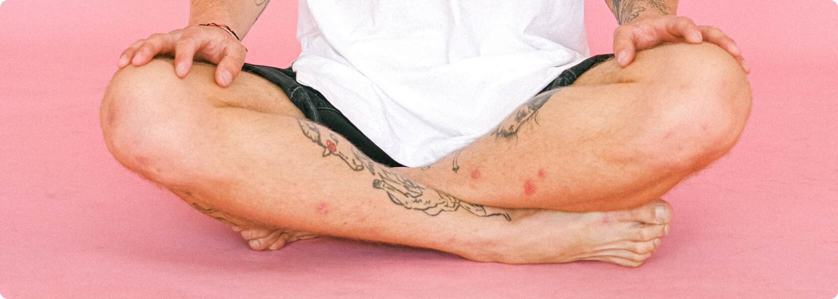 Erythema nodosum (Knotenrose) - Wie ist die Prognose bei einem Erythema nodosum?