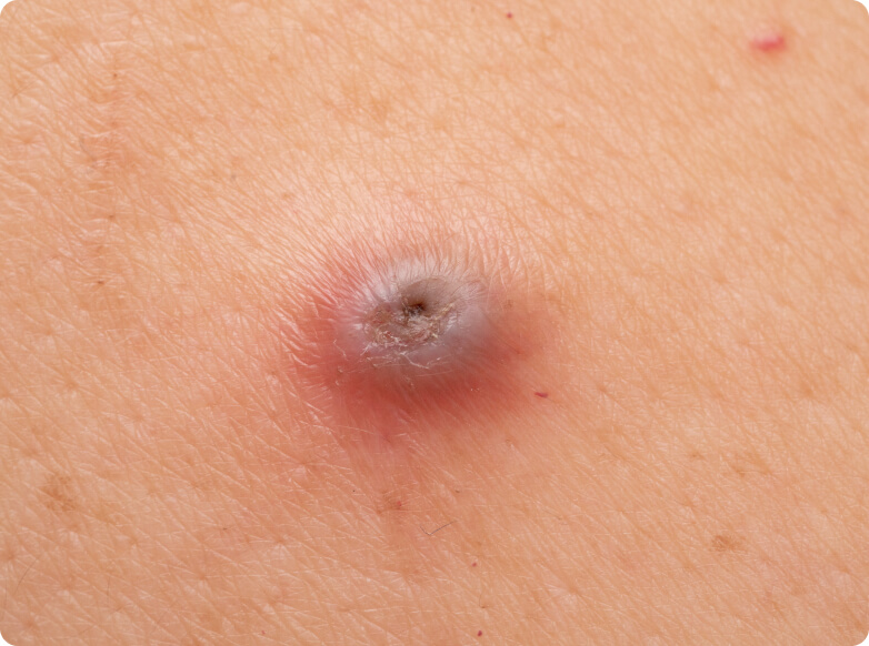 Follikulitis - Welche Ursachen hat eine Follikulitis?