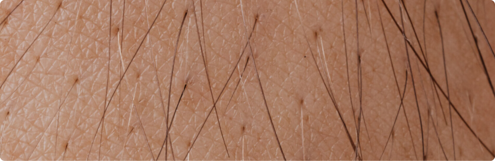 Follikulitis - Welche Therapie eignet sich bei einer Follikulitis?