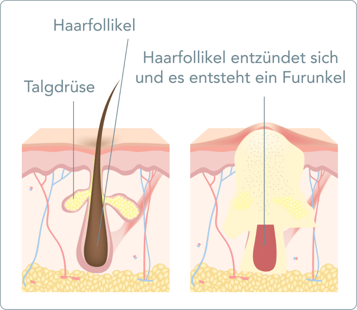 Furunkel - Welche Ursachen hat ein Furunkel?