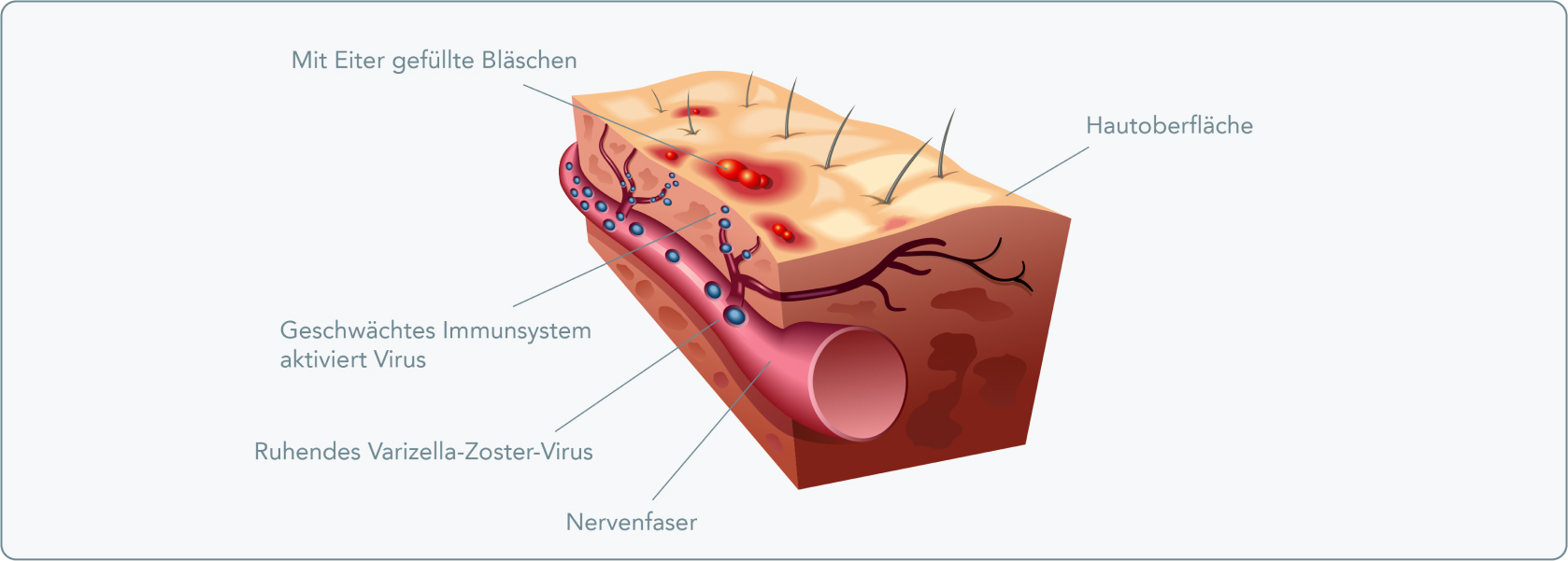Gürtelrose (Herpes Zoster) - PCR (Polymerase-Kettenreaktion)