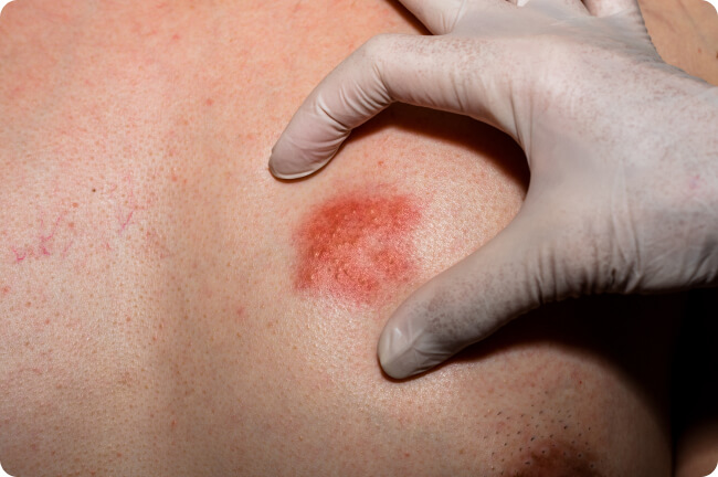 Gürtelrose (Herpes Zoster) - Welche Untersuchungen sind für die Diagnose einer Gürtelrose notwendig?