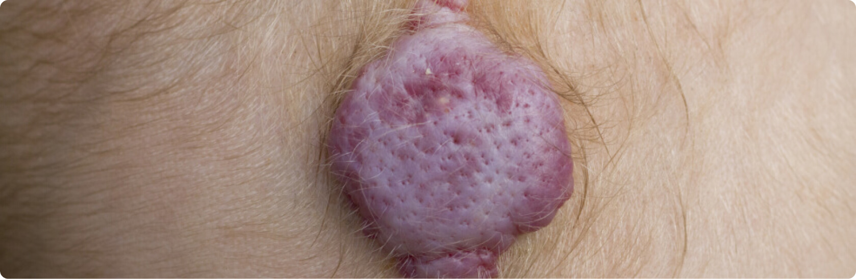 Hämangiom (Blutschwämmchen) - Was versteht die Medizin unter einem Hämangiom?